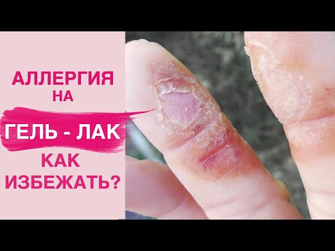 Видео: АЛЛЕРГИЯ на гель лак | Вся правда о гипоаллергенных базах