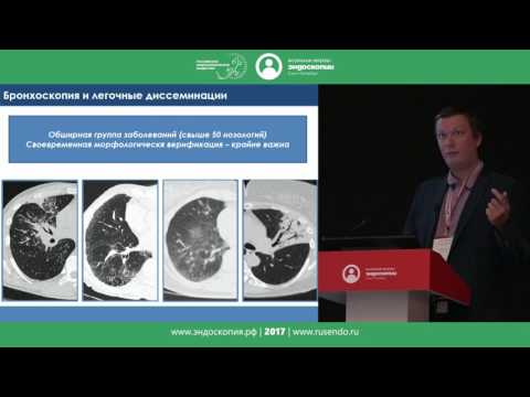 Видео: Бронхоскопия глазами пульмонолога