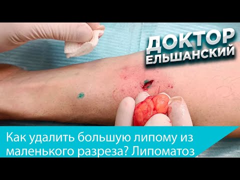 Видео: Как удалить большую липому из маленького разреза  Липоматоз