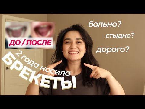 Видео: ПОСМОТРИ прежде, чем ставить брекеты | ДО И ПОСЛЕ, мой опыт, история, советы