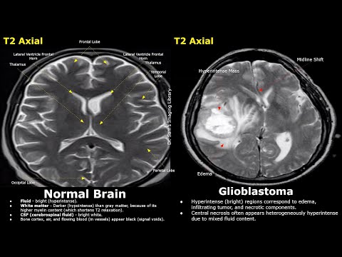 Видео: Нормальные результаты МРТ головного мозга против глиобластомы T2 и FLAIR | Высокозлокачественные ...