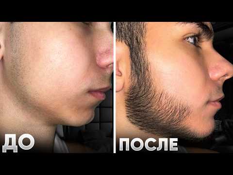 Видео: Результаты ксилноксина для бороды (с фото за каждый месяц)