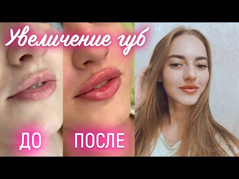 Видео: ВТОРОЙ РАЗ УВЕЛИЧИЛА ГУБЫ 👄 💉 подробно про ощущения во время вколов, реабилитация прошла иначе...