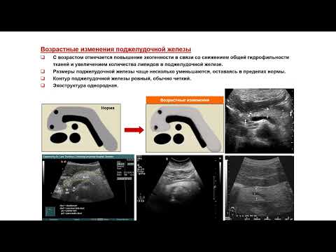 Видео: Ультразвуковая диагностика. Доктор Иогансен. Выпуск 45. Диффузные  изменения поджелудочной железы.