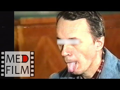 Видео: (R) Шизофрения. Кататонический синдром © Catatonic syndrome. Psychiatry