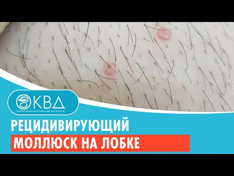 Видео: 🙁 Рецидивирующий моллюск на лобке. Клинический случай №924