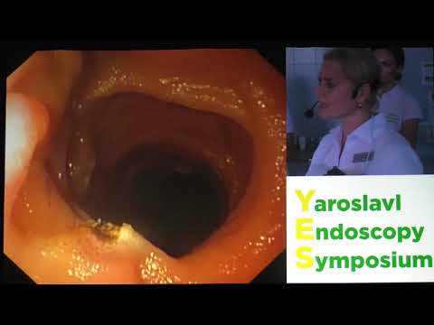 Видео: 16Live Иванова ЕВ Энтероскопия 1 баллонная Коагуляция ангиоэктазий тонкой кишки при ЖДА