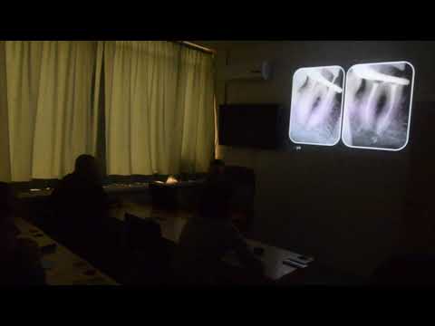 Видео: Определение рабочей длины. Курс Ребриева Евгения Юрьевича "Инструментальная обработка каналов 2.0"