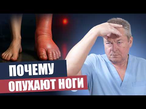 Видео: Отёки ног: главные причины и эффективные советы