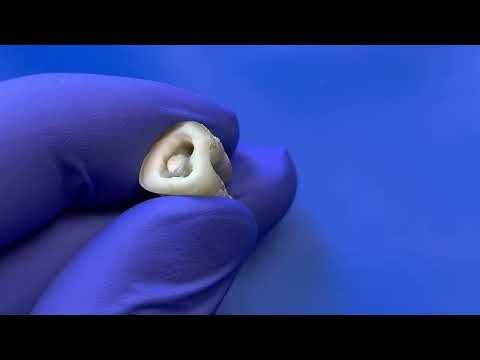 Видео: Часть 2. Как закрывать перфорацию на дне полости зуба, в области фуркации. Цемент МТА. Периодонтит