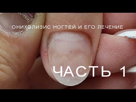 Видео: Онихолизис  Как вылечить онихолизис  Что такое онихолизис. Проблемные ногти.