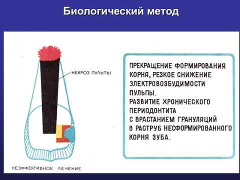 Видео: Пульпит постоянных зубов с несформированными корнями
