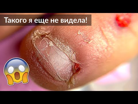 Видео: Очень Обгрызенные ногти / Проблемная кутикула - Маникюр и Наращивание