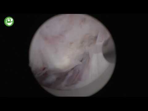 Видео: Секция живой хирургии: Тулиевая энуклеация гиперплазии простаты