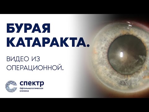 Видео: Лечим зрелую бурую катаракту с помощью микротравматичных технологий: Врач Унгурьянов.