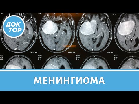 Видео: Менингиомы головного мозга: симптомы, диагностика, лечение