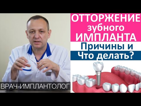 Видео: Что делать, если произошло отторжение зубного импланта. Приживляемость импланта, кто платит за новый