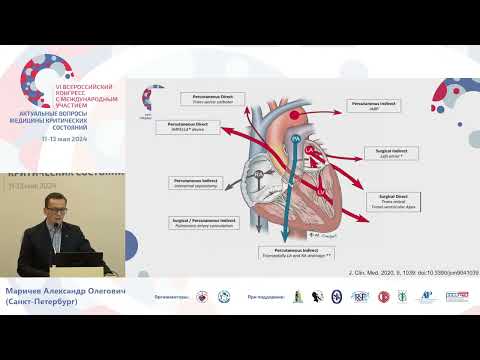Видео: Разгрузки левых отделов сердца при  экстракорп КО Маричев А.О.