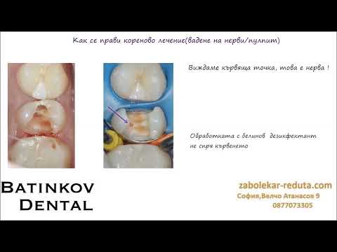 Видео: Как се прави кореново лечение/пулпит/вадене на нерви