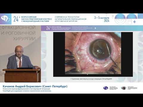 Видео: Технология кераторефракционной и лентикулярной экстракции SmartSight для коррекции астигматизма