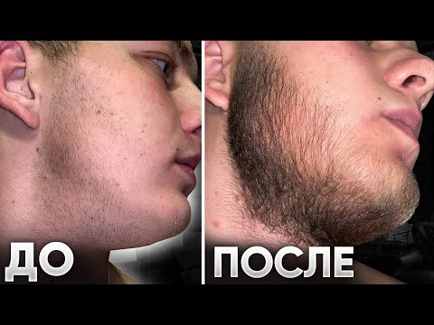 Видео: Вот как работает средство для роста бороды / Результаты mr Volos