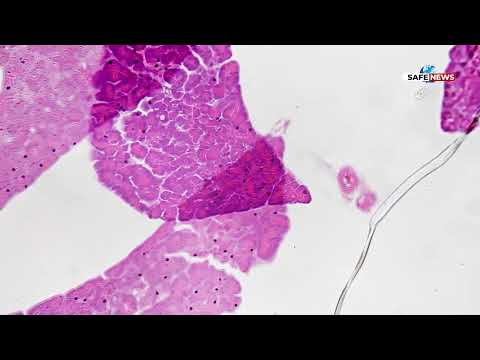 Видео: ВНИМАНИЕ! Силните болки в корема могат да алармират за проблеми с панкреаса