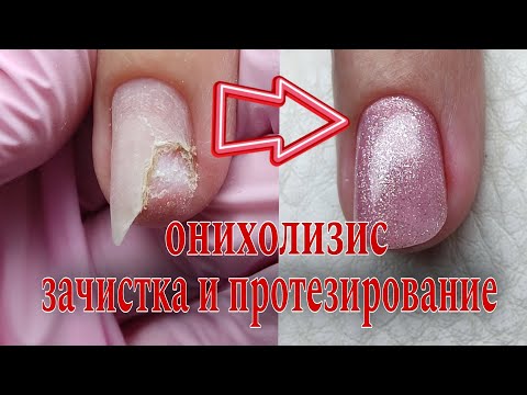 Видео: 😨ОНИХОЛИЗИС/ зачистка и протезирование👌🏻