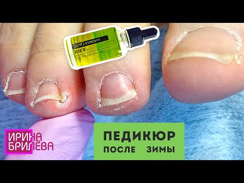 Видео: ПОЧЕМУ воспаляются пальцы? 🌸 ТЩАТЕЛЬНЫЙ педикюр 🌸 ПРЕОБРАЖЕНИЕ после зимы 🌸 Ирина Брилёва