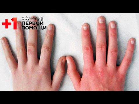 Видео: Отморожение || Первая помощь при отморожении || Проект+1