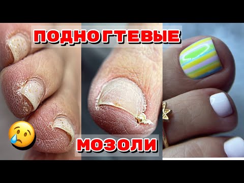 Видео: Подногтевая мозоль срослась с кожей 🤪 Сухие ножки 🦶 Педикюр