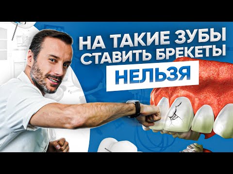 Видео: Все нюансы установки брекетов при наличии имплантов