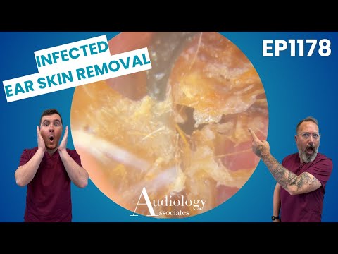 Видео: Удовлетворительное удаление инфицированной кожи, которое вы должны увидеть! - EP1178