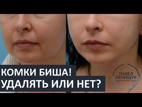 Видео: Комки Биша: УДАЛЯТЬ или НЕТ? | Вопросы и ответы