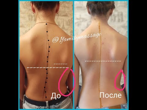 Видео: Массаж при Сколиозе.