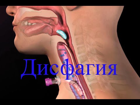 Видео: Инсульт. Дисфагия. Тренировочный метод в восстановлении глотательного рефлекса
