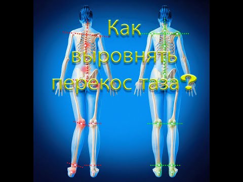 Видео: Как выровнять перекос таза? Лучшие упражнения! От ведущих докторов планеты!