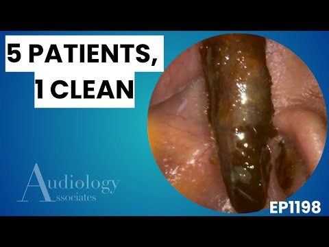 Видео: Невероятное удаление ушной серы – огромные кератиновые и липкие пробки - EP1198
