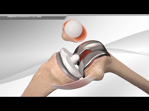 Видео: Замена коленного сустава - sustavy.od.ua
