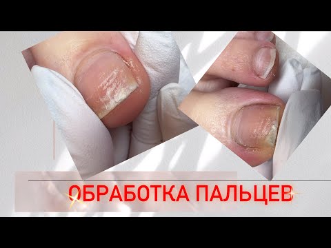 Видео: Педикюр 🦶/ Обработка пальцев ног #педикюр #стопы #мозоли
