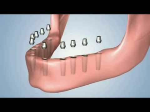 Видео: Замяна  на зъбите със зъбни импланти и протези - CityDent