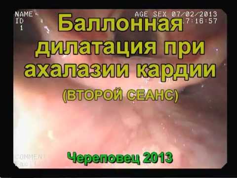 Видео: Баллонная дилатация при ахалазии кардии.