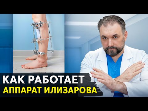 Видео: НЕ ставь Аппарат Илизарова, пока не посмотришь ЭТО видео