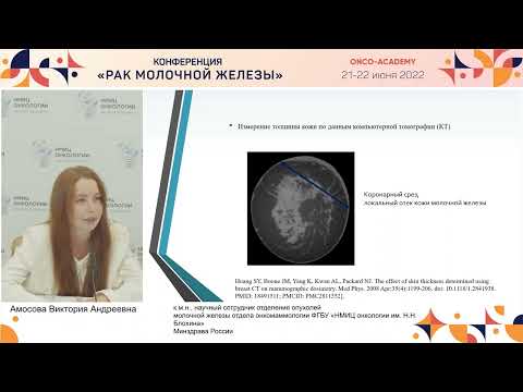 Видео: Объективизация оценки отека кожи у больных местнораспространенным раком молочной железы.Амосова В.А.
