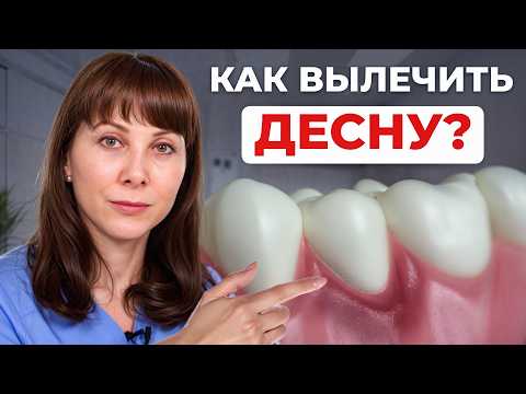 Видео: Быстрый способ снять воспаление десны ДОМА! Как вылечить ГИНГИВИТ самостоятельно?