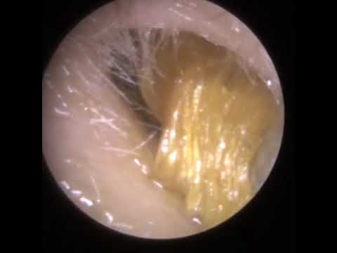 Видео: 805 - Удаление обтурирующего кератоза у пожилого клиента с узким ухом