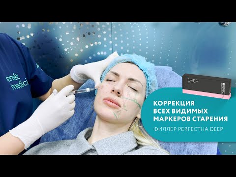 Видео: Perfectha Deep – лучший препарат для коррекции всех видимых маркеров старения