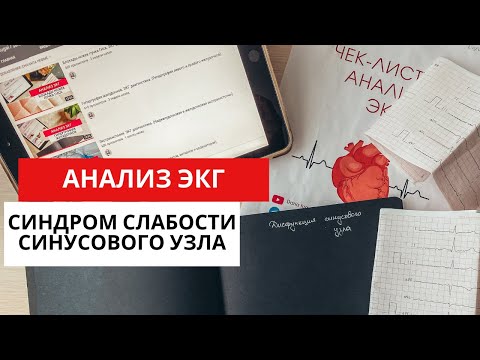 Видео: Синдром слабости синусового узла (СССУ-дисфункции синусового узла). ЭКГ. Причины. Симптомы.