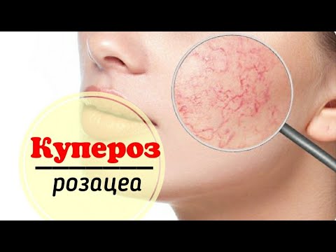 Видео: Купероз и розацеа: работаем ампульными концентратами с пептидами