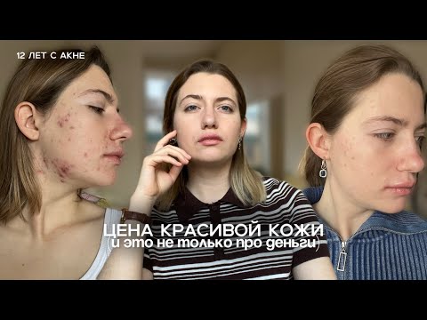 Видео: акнекутан || стоит ли того | результат терапии | побочки