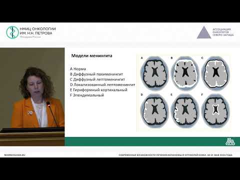 Видео: Редкие иммуноопосредованные осложнения: нейротоксичность